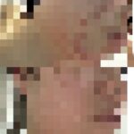 鬱とニキビの悪循環を断った私の方法｜体験談