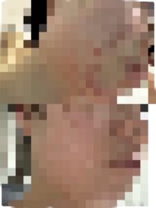 鬱とニキビの悪循環を断った私の方法｜体験談